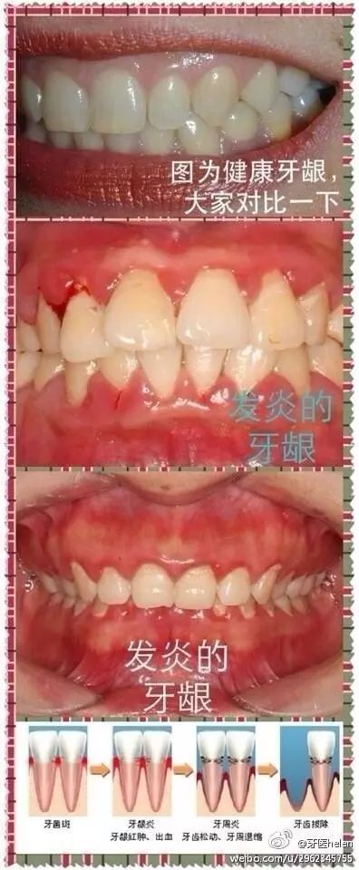 牙医helen齿科中心——牙龈炎