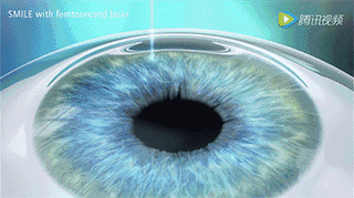 无进行性眼病,能通过全飞秒近视手术术前检查,眼部条件比飞秒激光更为