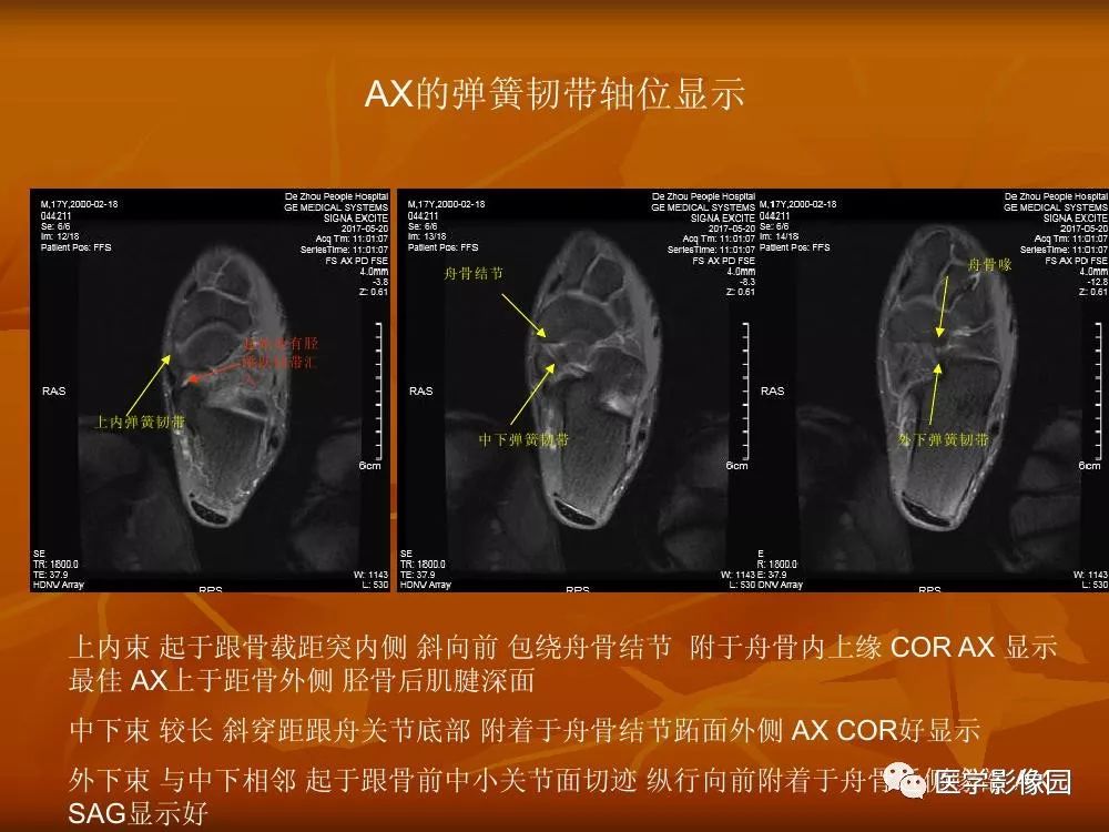 踝关节韧带的解剖及影像表现丨影像天地