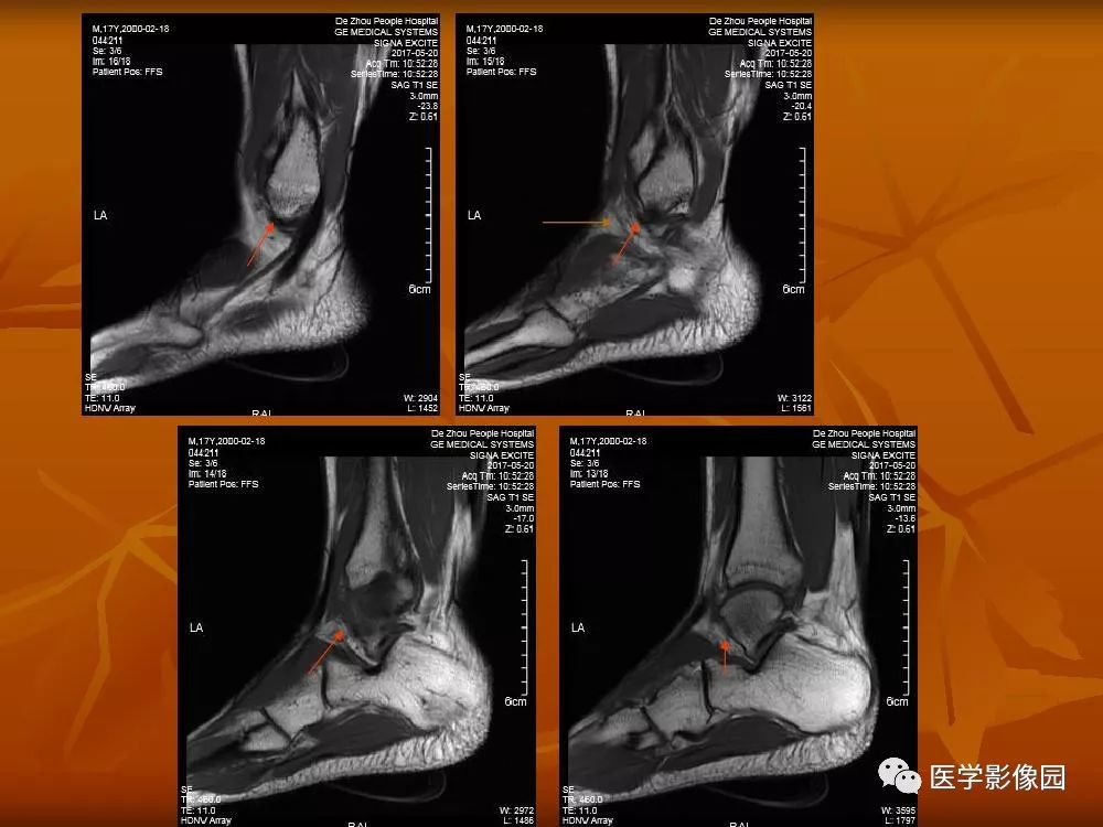 踝关节韧带的解剖及影像表现丨影像天地
