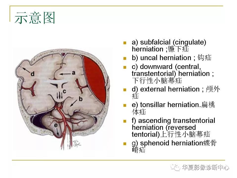 图解脑疝