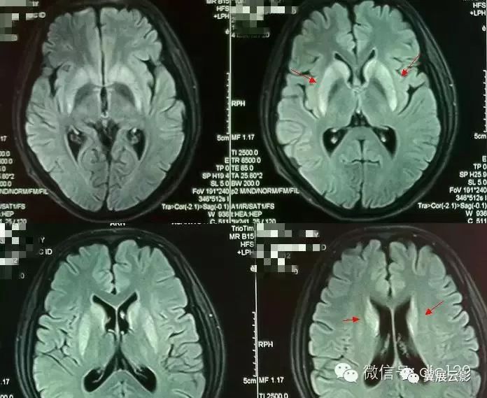 8例神经系统疾病典型影像学表现