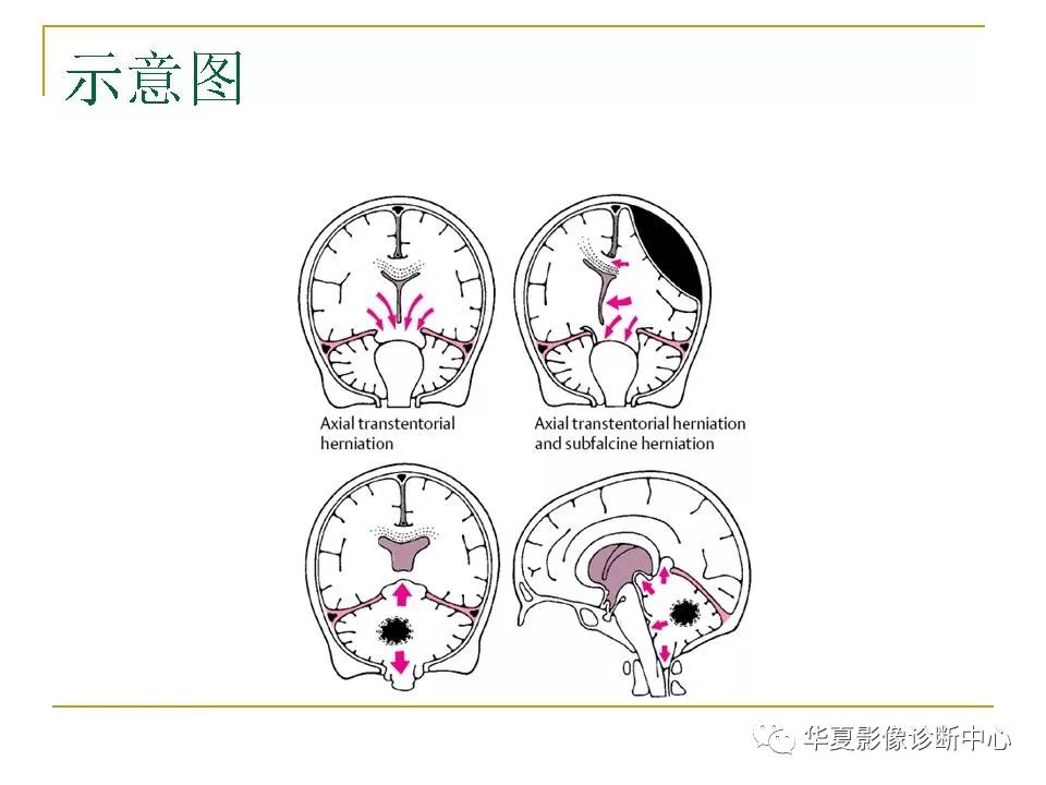 图解脑疝