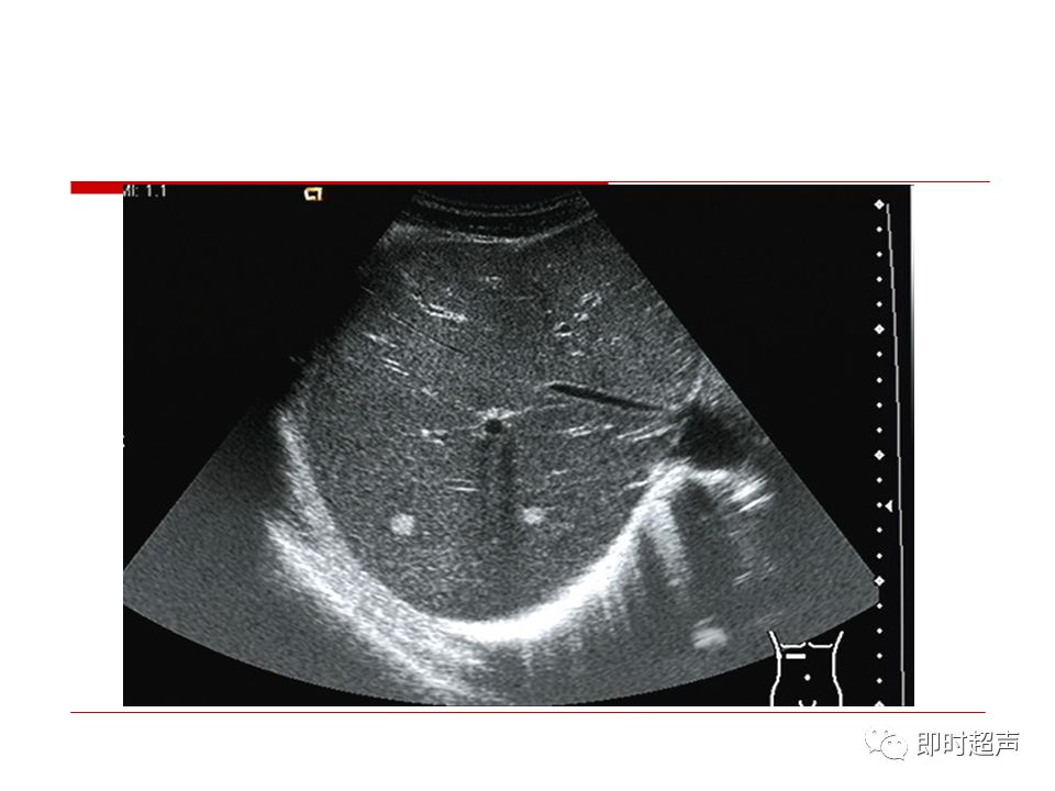 肝脏解剖及超声表现
