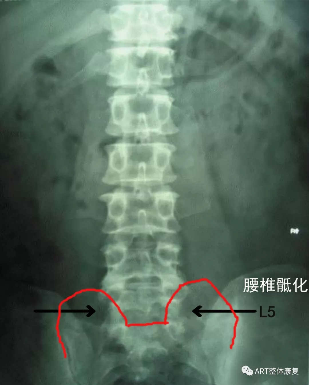 腰椎骶化椎间盘病变ct片:中央型腰椎间盘突出椎间盘病变ct片:左侧椎