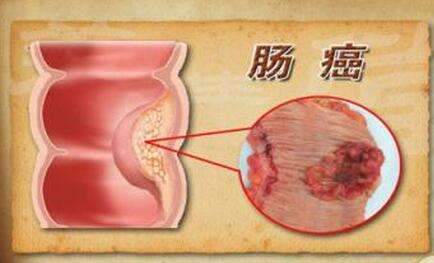 昆明肠镜检查在线咨询|人到中年怕肠癌?去查个肠镜吧