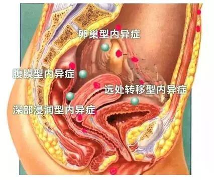 (图:子宫内膜异位症示意图) 返回搜