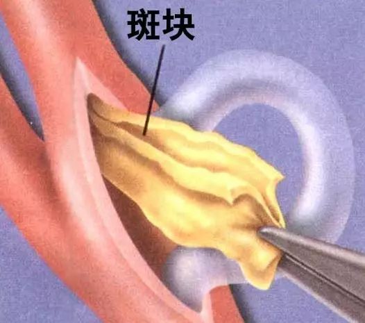 堵奶有硬块冷敷是什么原理_小腿有硬块是什么症状(3)