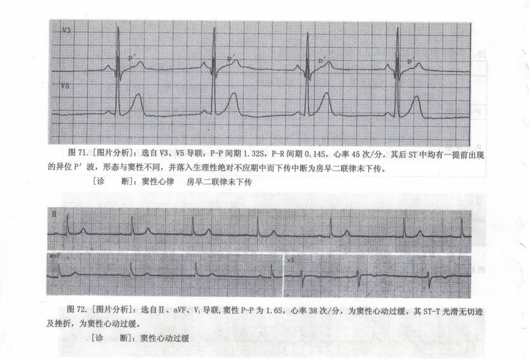 心电图的鉴别诊断图片解读