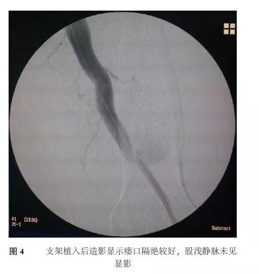 【学术动态】下肢动静脉瘘的介入治疗