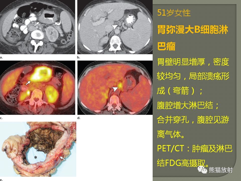 原发性胃肠道淋巴瘤的影像诊断及鉴别诊断