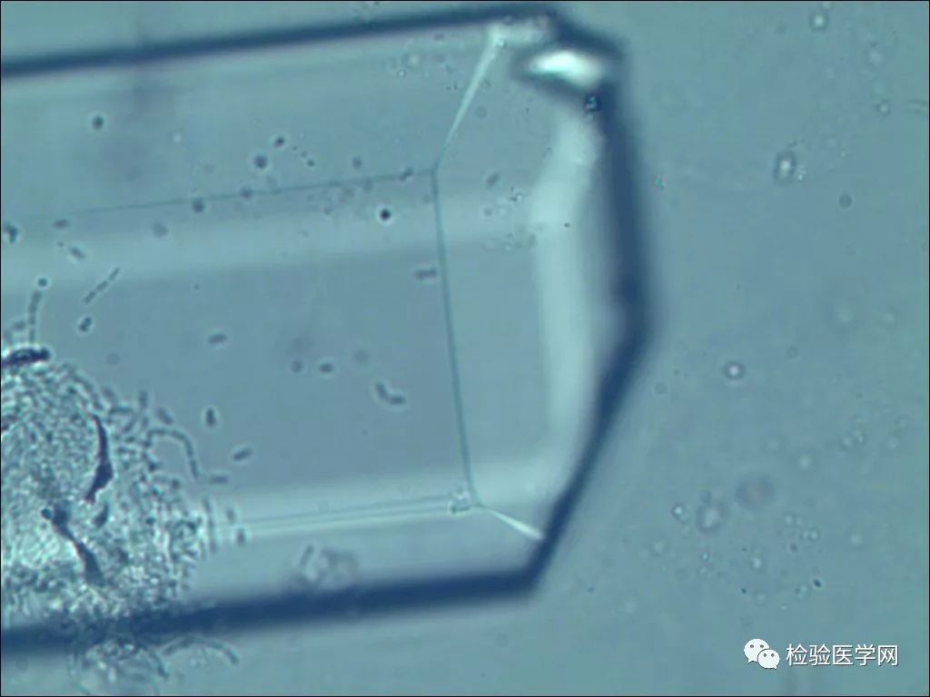 37.偏振光显微镜下关节液中负性双折光尿酸盐针状结晶-现代风湿性疾病·-医学