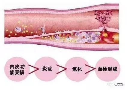 人体的血管内皮在高血脂,高血压以及吸烟等因素的影响下会受到损伤