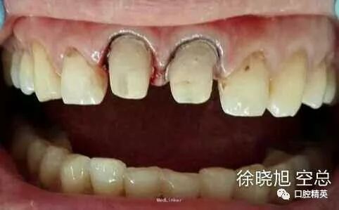诊断:牙髓坏死治疗计划:根管治疗 牙龈切除术 桩核冠修复 上前牙修复