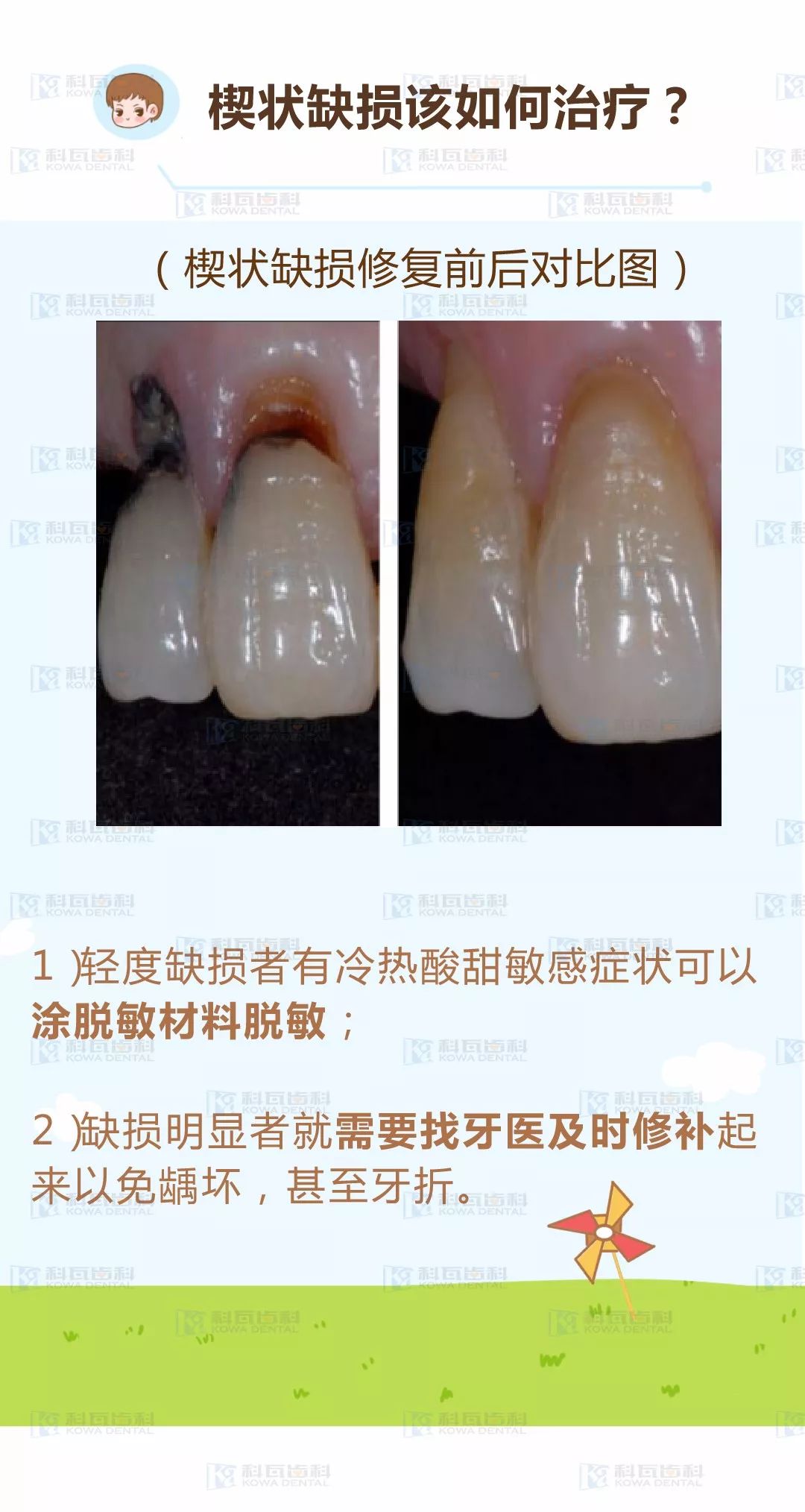 牙齿吃冷热酸甜总酸疼,照镜子发现牙颈部有个小棱竟是