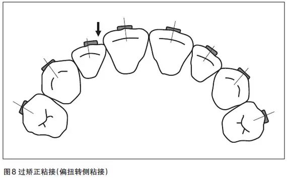 【牙医学堂】自锁托槽临床应用的技术要点