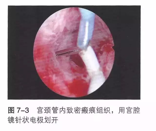 干货宫腔粘连宫腔镜的手术步骤