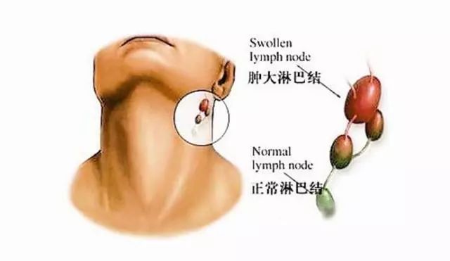 当淋巴结肿大时,可触到皮肤下有 圆形,椭圆形或条索状的结节.