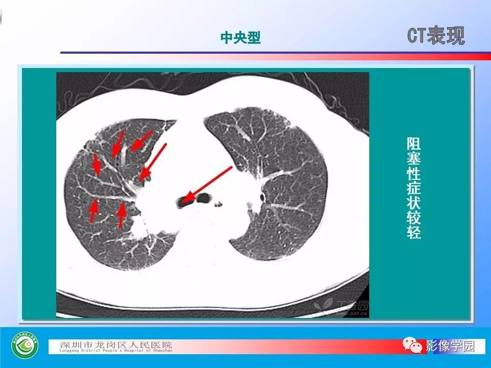 向子云主任—《小细胞肺癌的ct诊断和鉴别诊断》