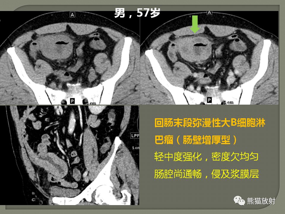 专题丨原发性胃肠道淋巴瘤的影像诊断及鉴别诊断