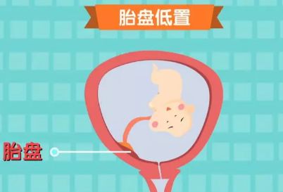 妊娠期间出血 胎盘的局部血液供非常丰富,如果胎盘位置距离宫颈口很近