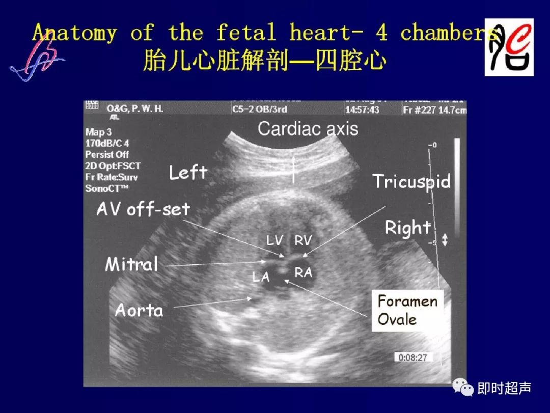 胎儿心脏的正常和异常超声解剖