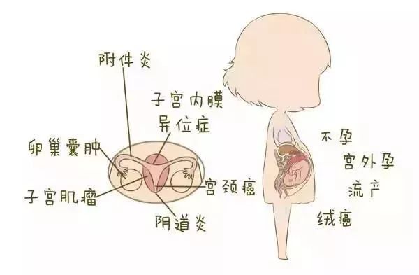 妇科一张女性妇科疾病地图赶紧对照自