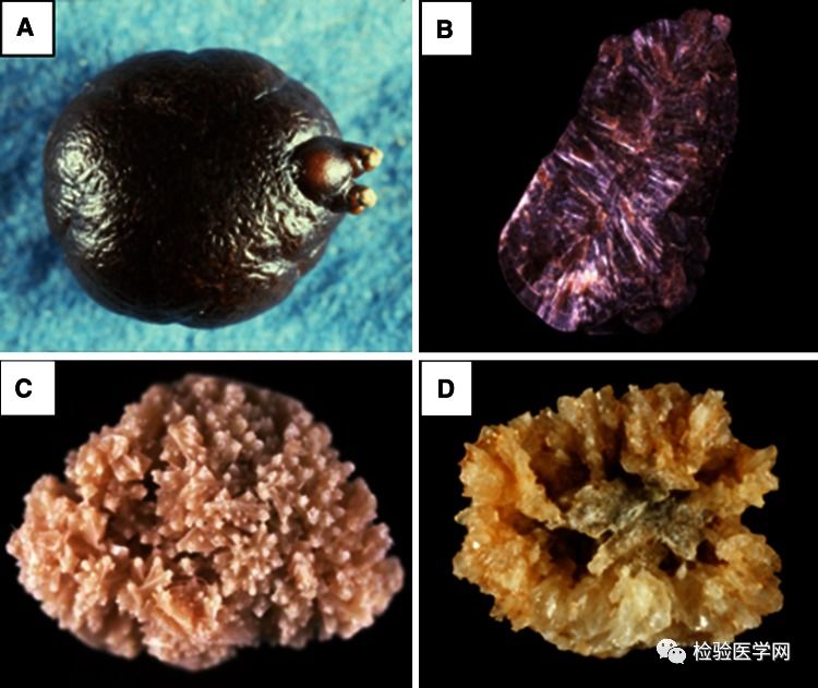 信封样磷酸铵镁结晶 磷酸钙结晶图片 附图尿液结晶体引起的尿路结石
