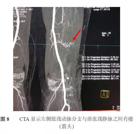 【学术动态】下肢动静脉瘘的介入治疗