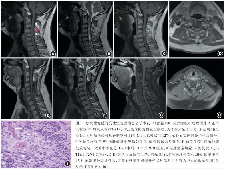 原发性脊髓间变性室管膜瘤的临床特点和诊治 |【中华神外】2018年第