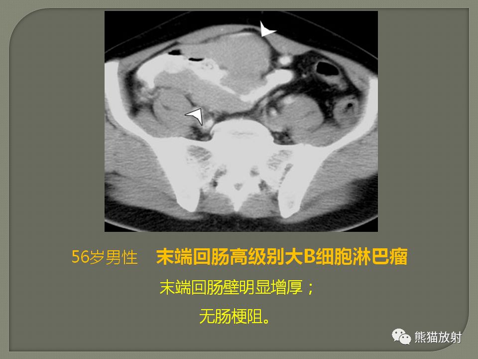 专题丨原发性胃肠道淋巴瘤的影像诊断及鉴别诊断