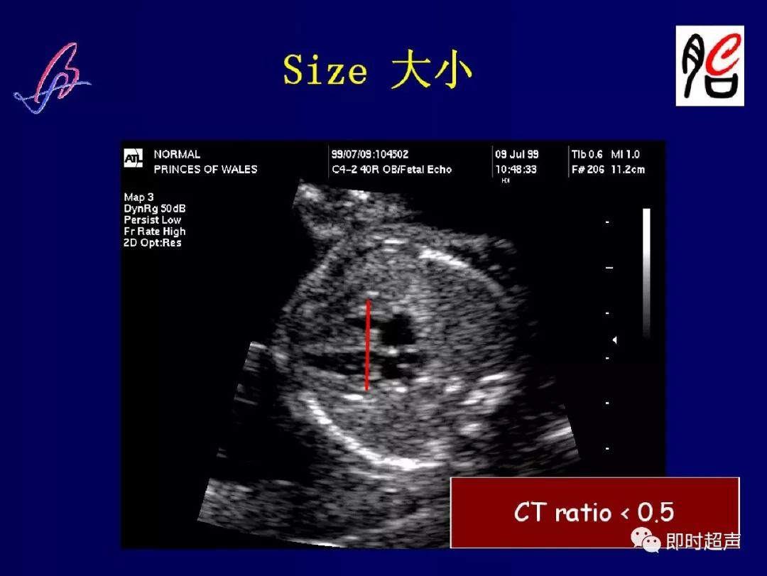 胎儿心脏的正常和异常超声解剖