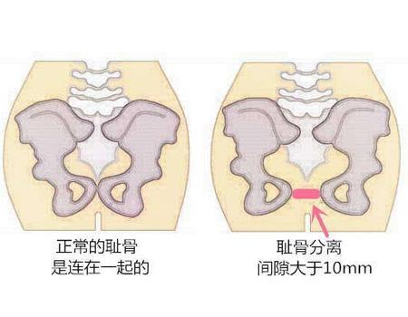 耻骨不知道,盆骨总知道了吧?