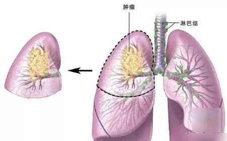 肺癌的早期症状