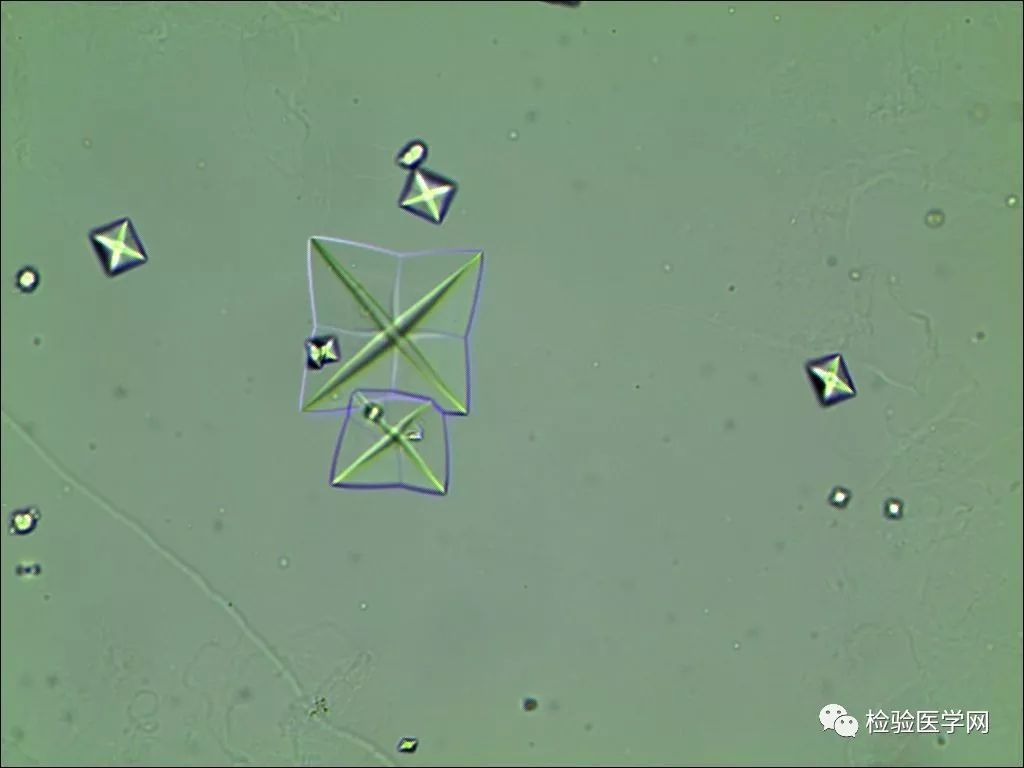 钙结晶图片结晶形态学(以下图片均采自笔者实验室日常尿液标本)尿液中
