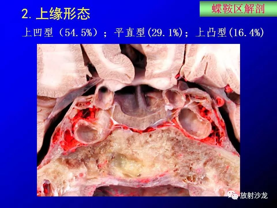 蝶鞍区解剖及疾病的影像解剖