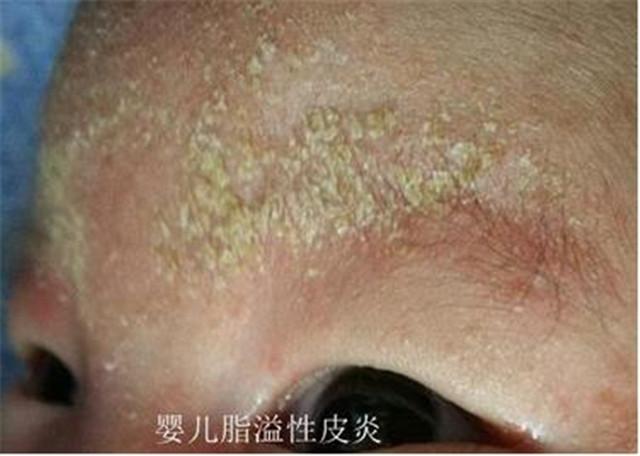 粟粒疹通常长在婴儿鼻部和面颊上的一种细小的白色或黑色的,突出在