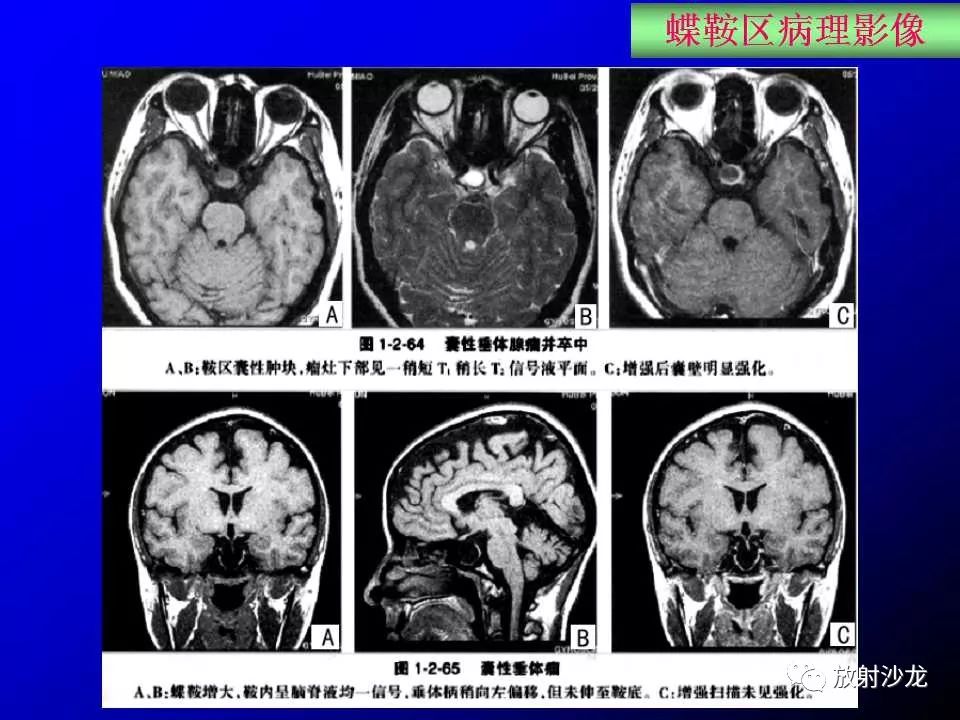 蝶鞍区解剖及疾病的影像解剖