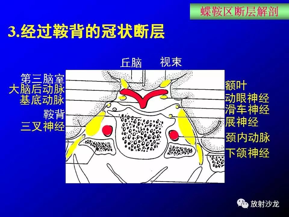 蝶鞍区解剖及疾病的影像解剖