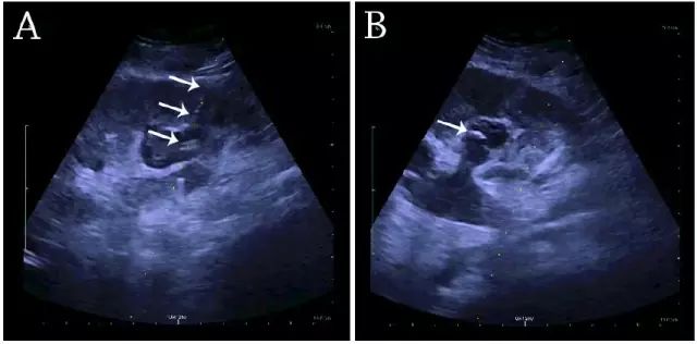 各类肾脏病超声图像表现