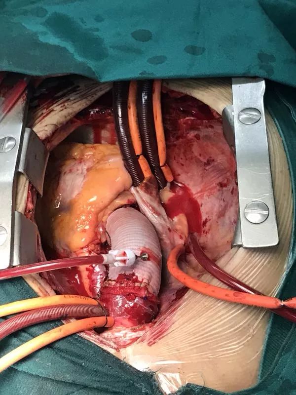 【病例分享】castor分支型主动脉覆膜支架系统治疗主动脉弓部夹层——