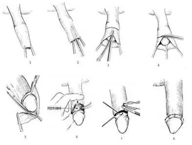 传统包皮环切术示意图
