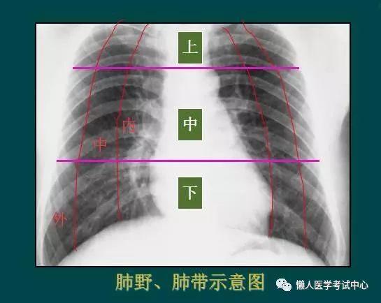 【读完此文,终于学会看胸片了】看完觉得胸片还挺简单.