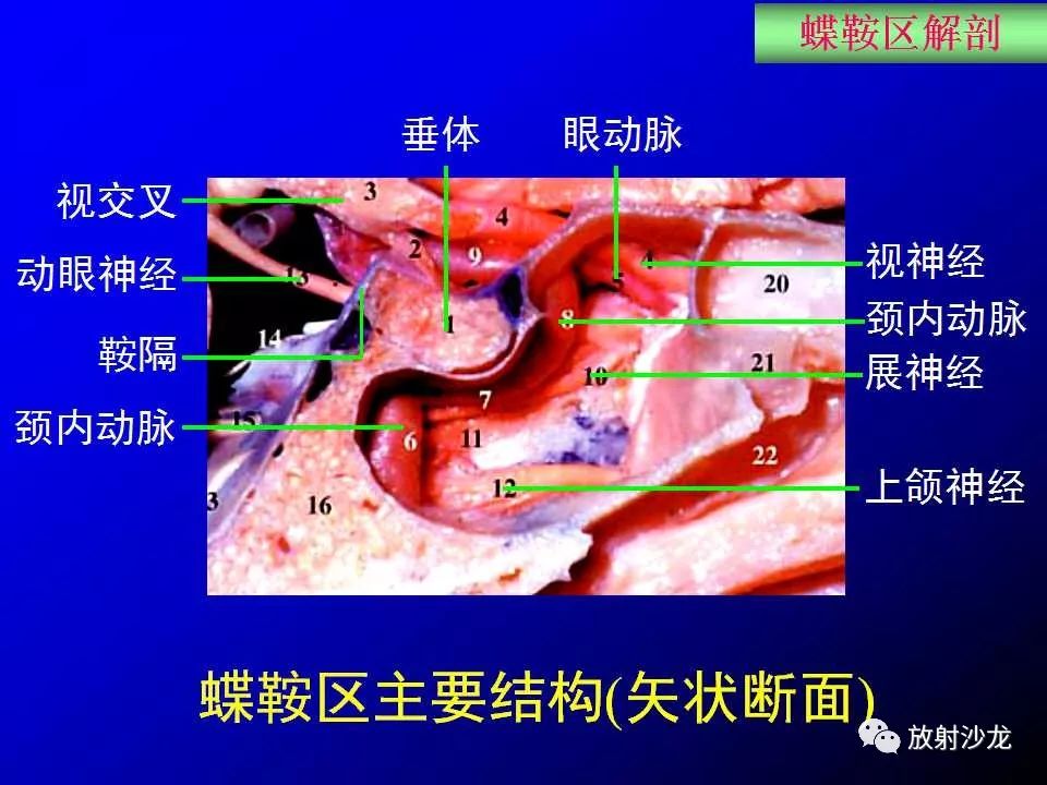 蝶鞍区解剖及疾病的影像解剖