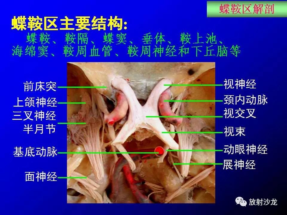 蝶鞍区解剖及疾病的影像解剖