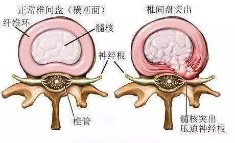 一招解决腰腿痛——腰椎间盘突出症的"打靶"治疗