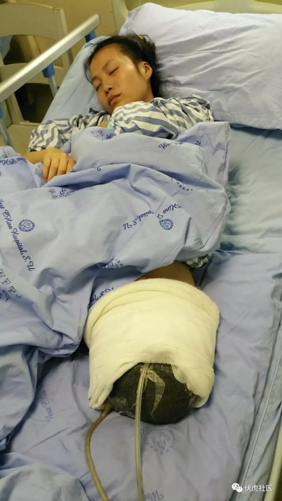 17岁少女在明珠广场外遭遇车祸,惨遭截肢