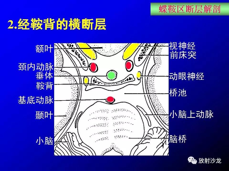 蝶鞍区解剖及疾病的影像解剖