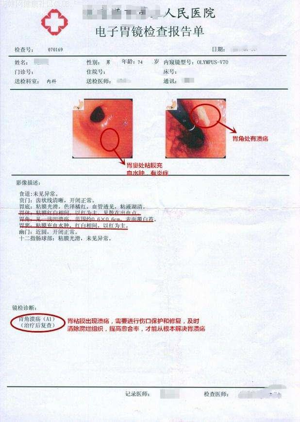 胃病症状提前知晓(常见三种胃病)不痛的胃病并不等于