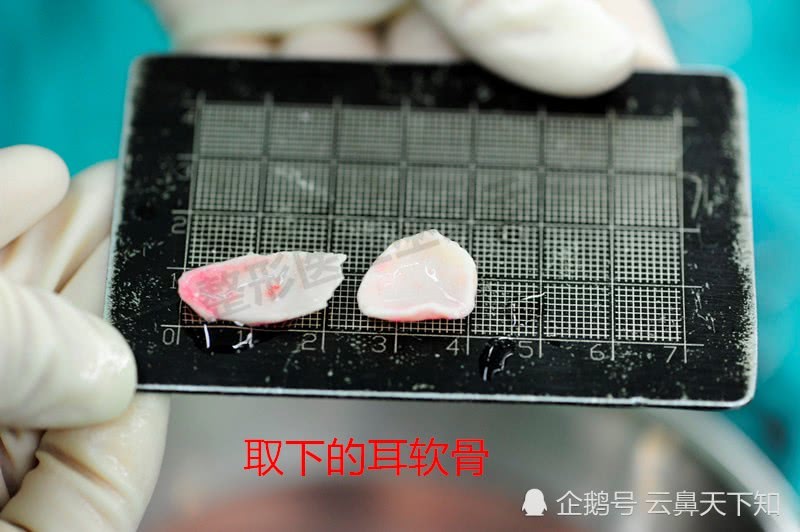 综合隆鼻选用耳软骨你知道为什么吗